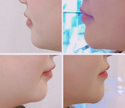 턱끝 필러 후기 